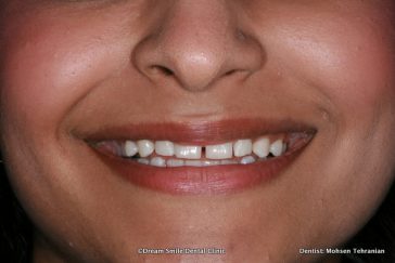 Before Composite veneers