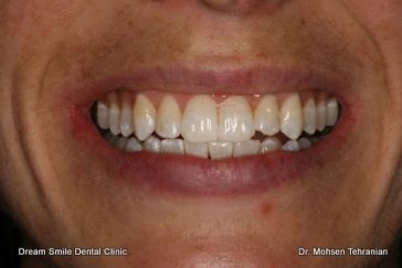 After Invisalign case 24