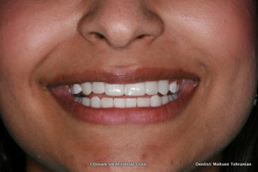 After Composite veneers