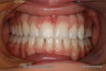 After Case 14  Invisalign teen