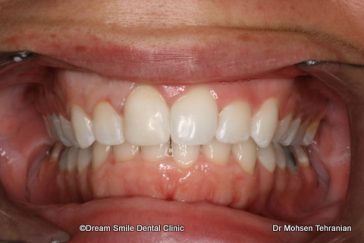 After Invisalign for narrow arch