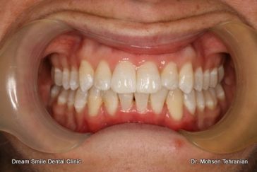 After Invisalign case 24