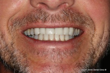 After Invisalign and emax veneers