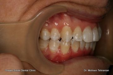 After Invisalign Case 25