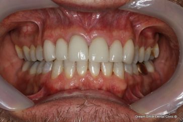 After Invisalign and emax veneers