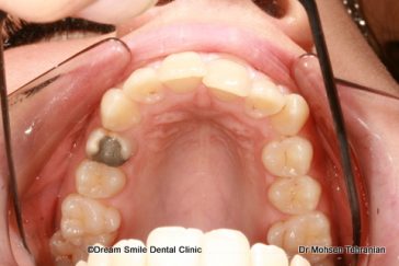 Before case 14 Invisalign teen