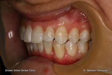 After Invisalign Case 25