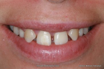 Before Invisalign then composite bonding