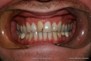 Before Combination of Invisalign and Crown