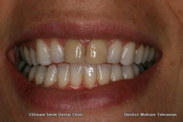 Before 2 Porcelain Veneers