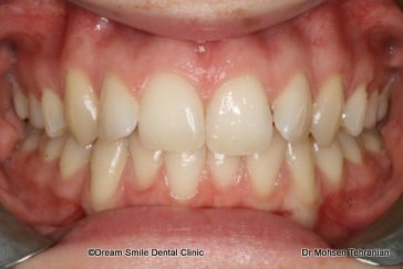 Before Six Month Smile Case 02