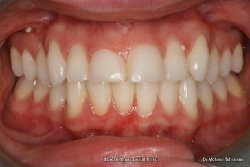 Before Case 06 Gum Contouring