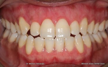 After Depigmentation gums