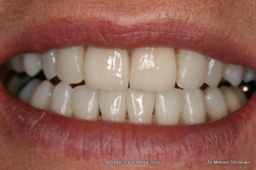 After Case 20 Veneers