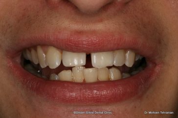 Before Six Month Smiles Case 01