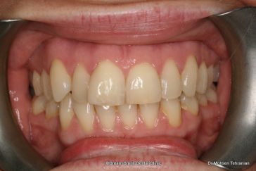 Before Six Month Smile Case 03