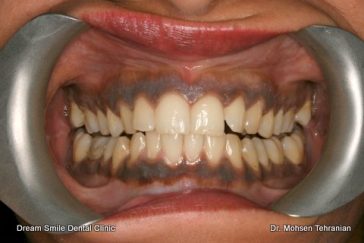 Before Case 05 Laser Gum Bleaching and depigmentation