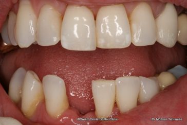 Before Porcelain Bridges  Case 04