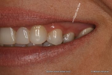 Before Laser Gum Contouring Case 05