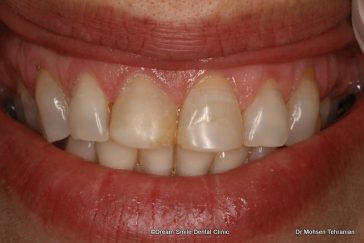 Before Composite Veneers Case 18