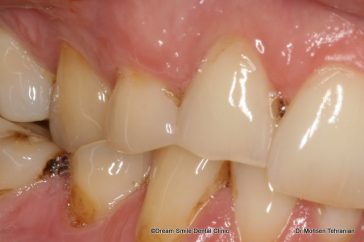 Before Case 04 Laser Gum Contouring