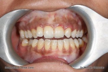 Before Case 06 Gum Dipigmentation