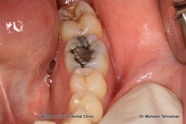 Before Fillings Case 06