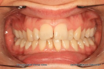 Before Invisalign, Whitening, Composite bonding