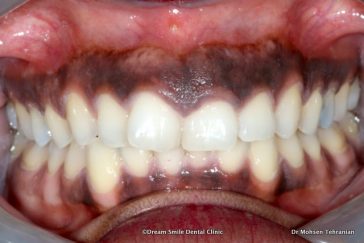 Before Gum Depigmentation London