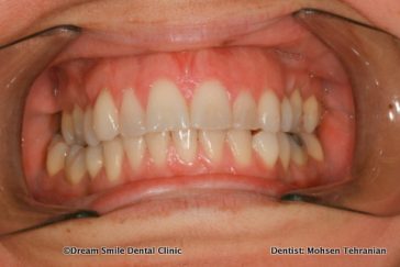 Before Whitening
