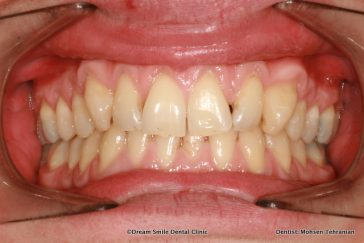 Before Composite Bonding and 2 Emax Crowns