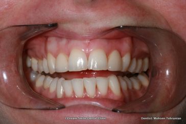 Before 10 Upper Emax veneers ,