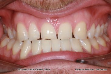 Before 3 Emax Veneers, 1 Composite Bonding , No Drilling !