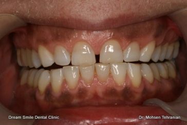 Before Gum Bleaching Case 1 Smile