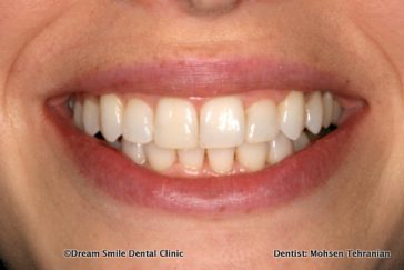 After Invisalign and composite bonding