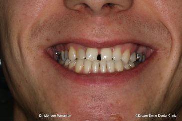 Before composite veneers to close gappy teeth