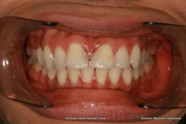 Before Lumineers upper and lower teeth