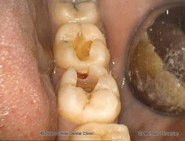 Before Fillings Case 05