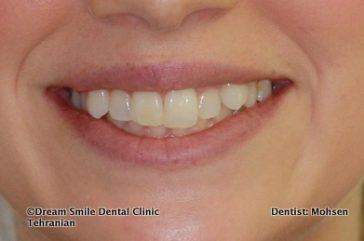 Before Invisalign and composite bonding