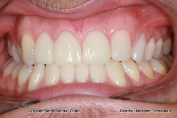 After 3 Emax Veneers, 1 Composite Bonding , No Drilling !