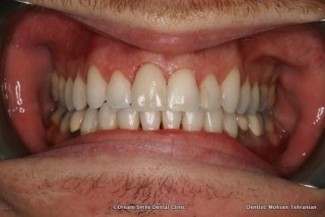After Combination of Invisalign and Crown