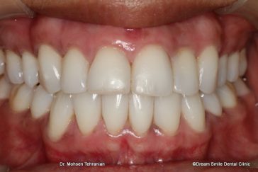 After Dark gum treatment