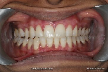 After Combination of Invisalign and Laser gum Surgery