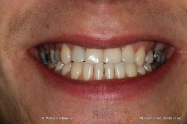 After composite veneers to close gappy teeth