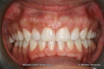 After Case 19 Invisalign