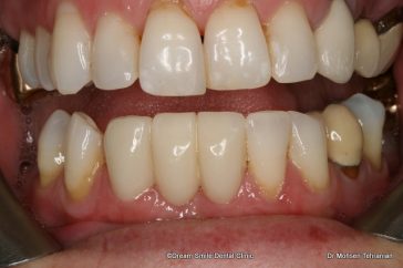 After Porcelain Bridges  Case 04