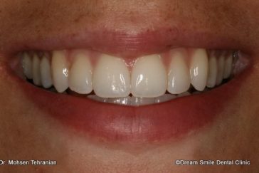 After Invisalign Lite