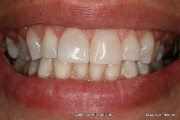 After Composite Veneers Case 18