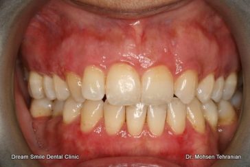 After Case 06 Gum Dipigmentation