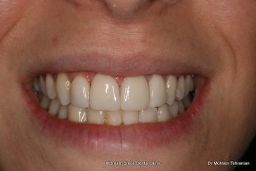 After Case 21 Veneers